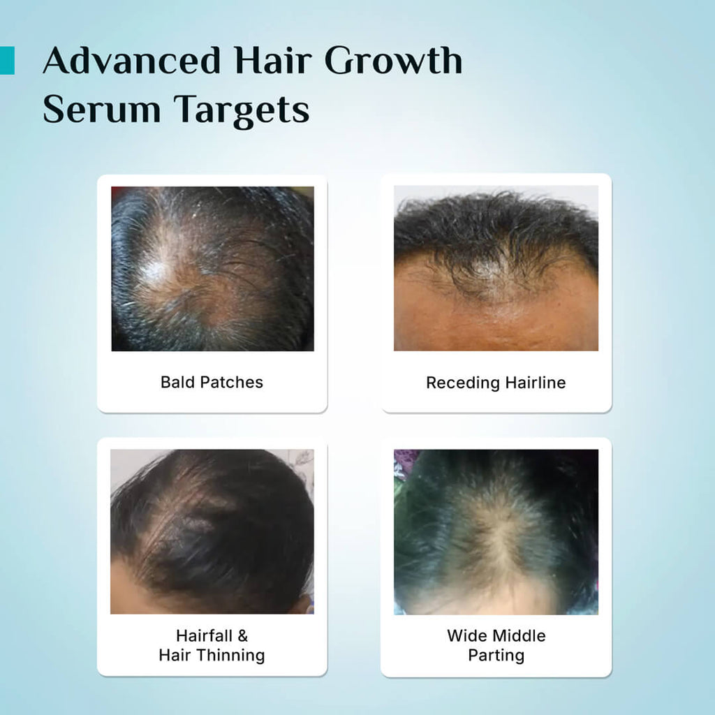 Pilgrim 3% Redensyl 4% Anagain Advanced Hair Growth Serum