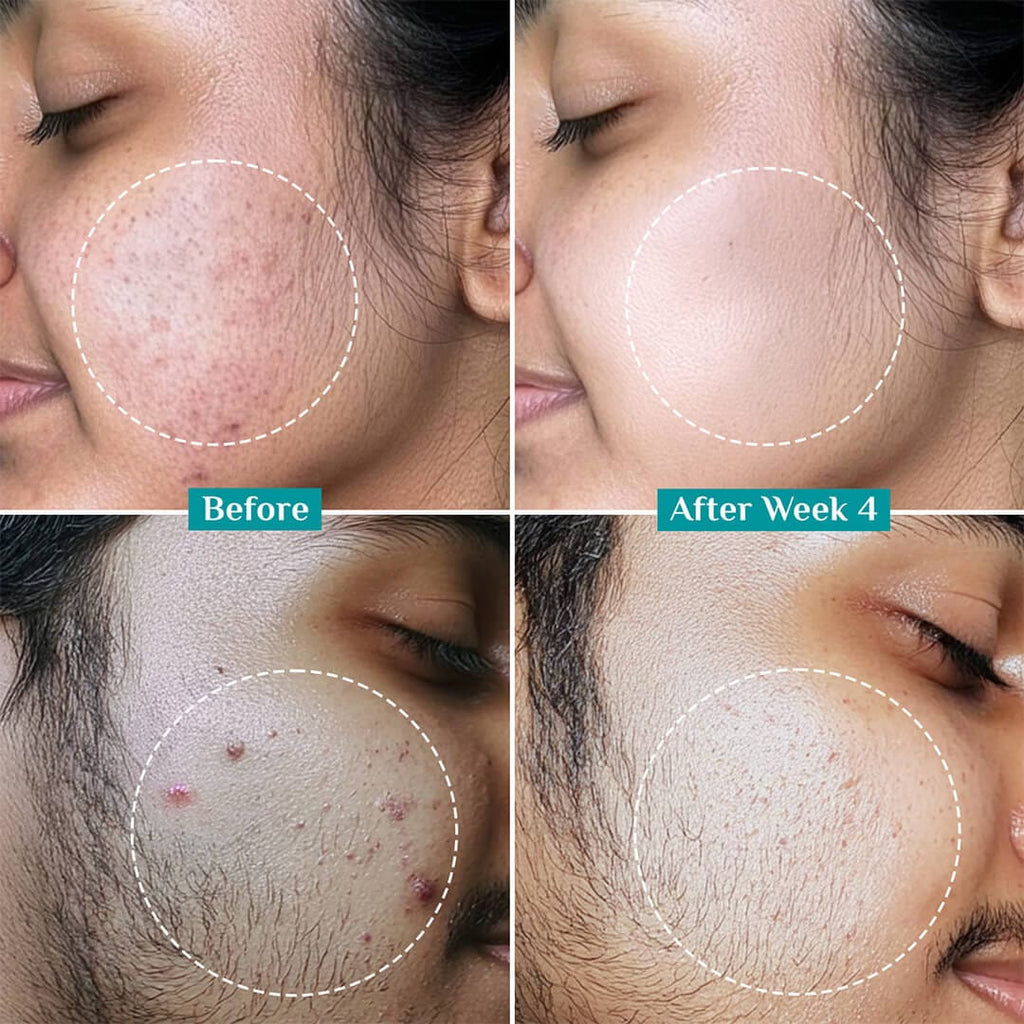 Pilgrim 2% Salicylic Acid Anti-Acne Face Serum