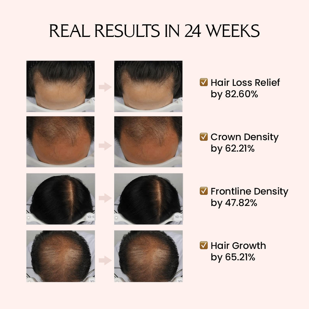 Lador Dermatical Hair- Loss Treatment (For Thin Hair) - 200ml