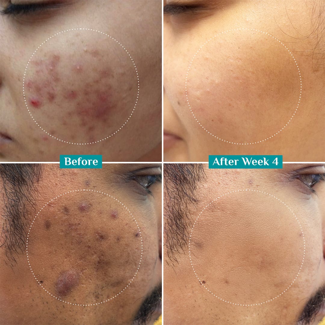 Pilgrim 10% Niacinamide Face Serum With 1% Zinc PCA