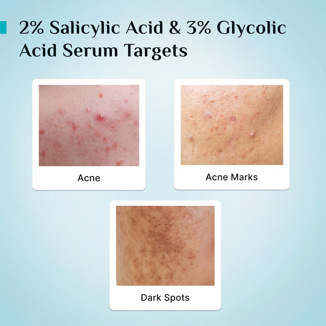 Pilgrim 2% Salicylic Acid Anti-Acne Face Serum
