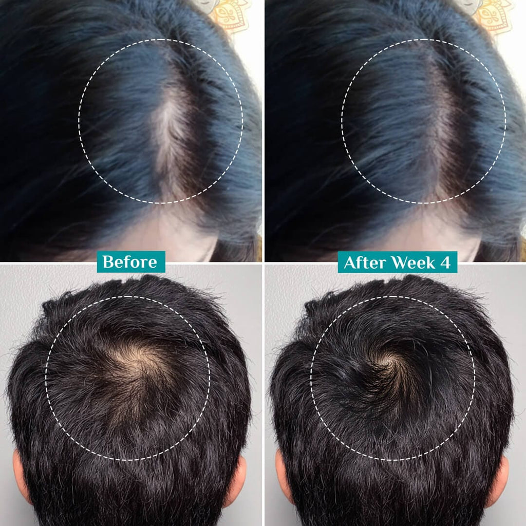 Pilgrim 3% Redensyl 4% Anagain Advanced Hair Growth Serum