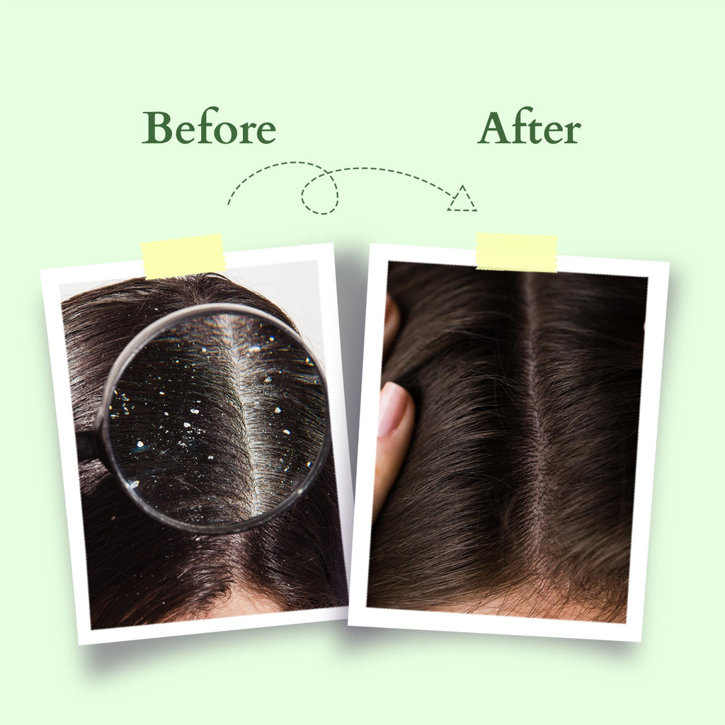 Lotus Organics+ Chemical-Free Anti-Dandruff Shampoo