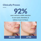 Fixderma Fixderma Salyzap Acne Spot Corrector Gel